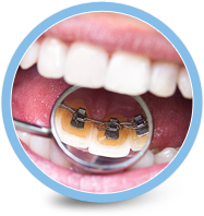 braces behind your teeth manhattan ny